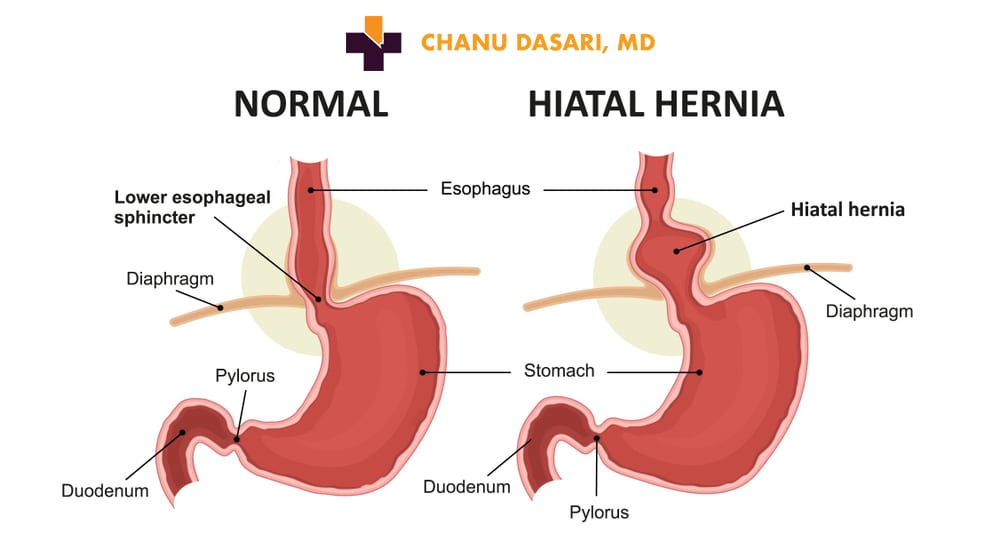 Hiatal Hernia Infographic