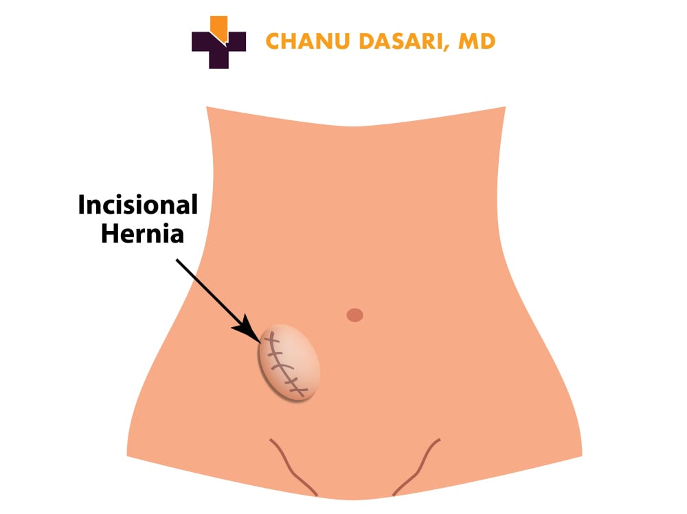 Incisional Hernia Infographic