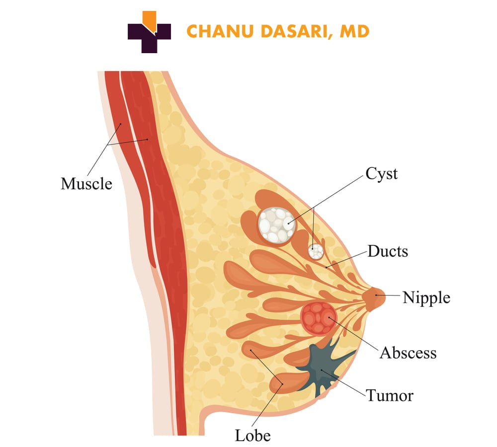 Infographic of Breast Cyst