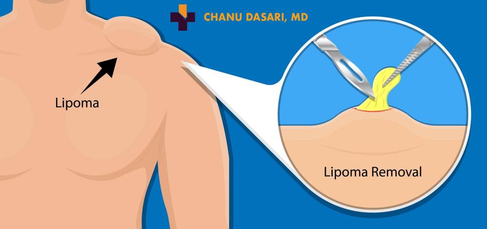 Surgery of removal lipomas formed under the skin