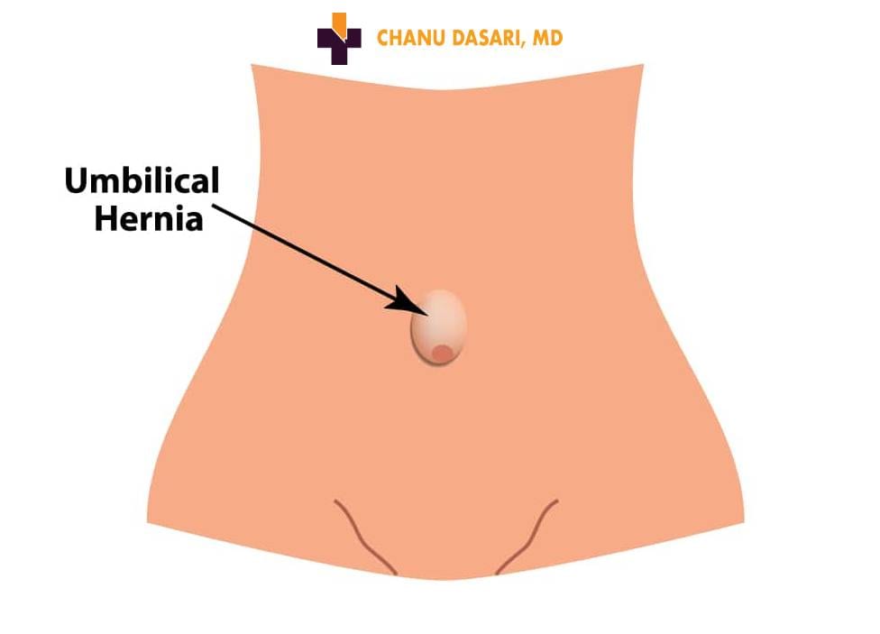 What is an Umbilical Hernia