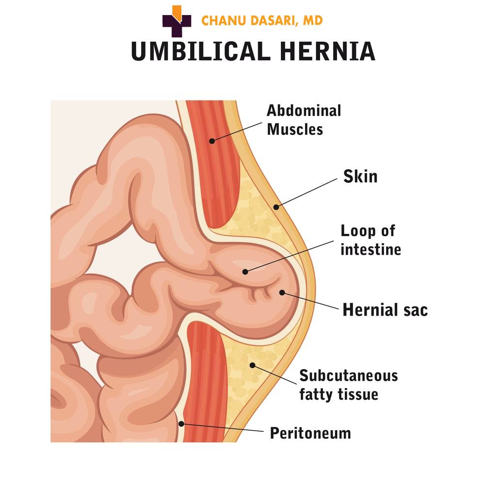 Symptoms of an Umbilical Hernia