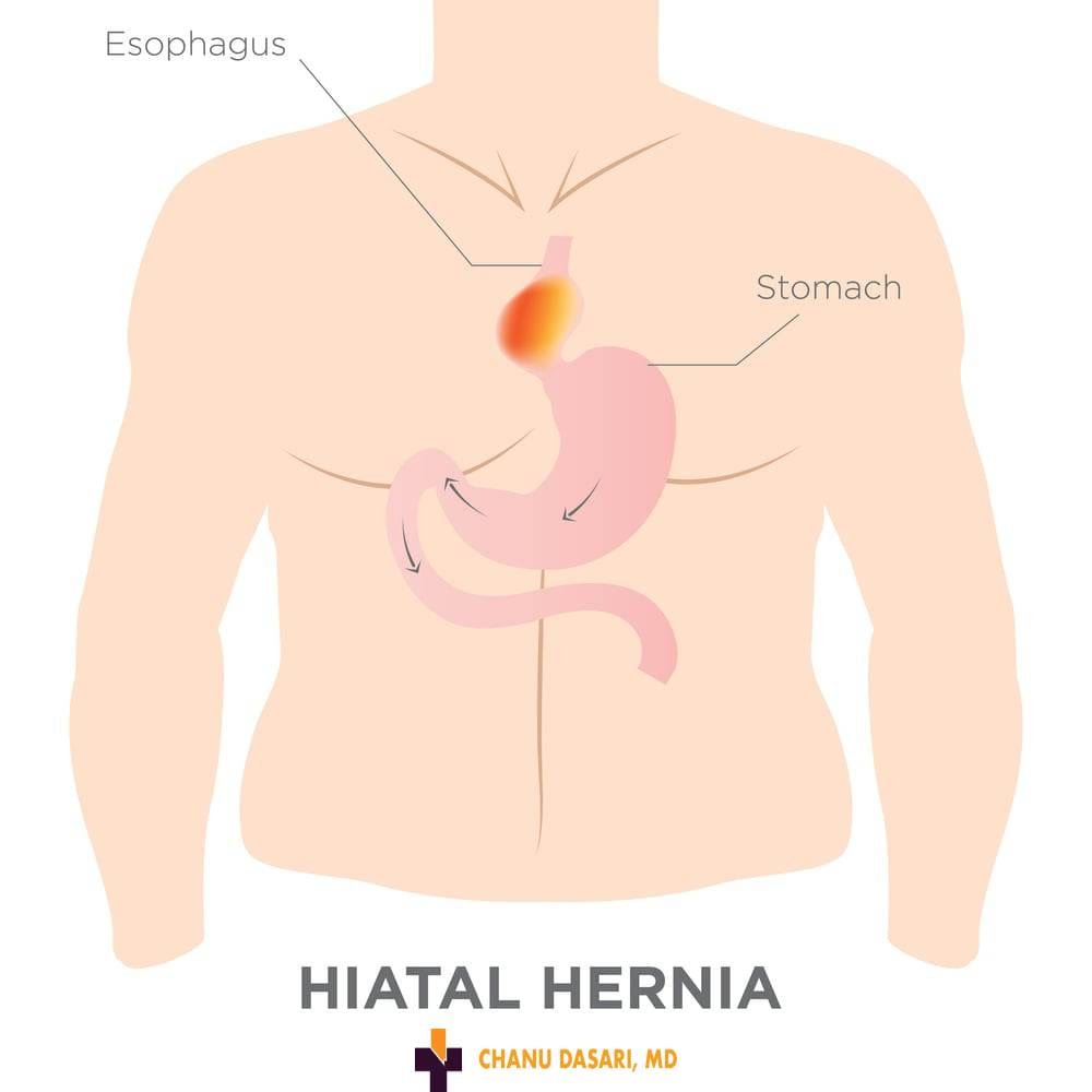 patient Need to repair of Hiatal Hernia 