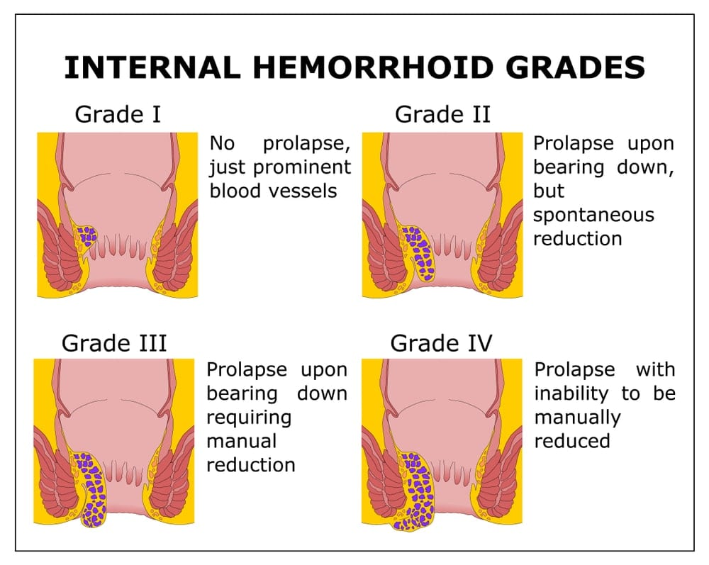 Stoutmoedig Verlaten Punt Hemorrhoids | Top Surgeon Dr. Dasari