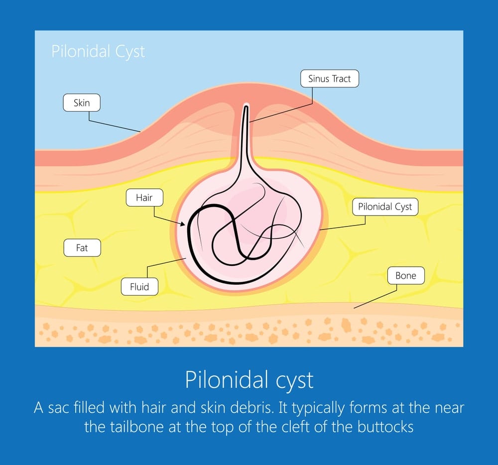 CSA Surgical Center - Pilonidal Cyst Removal